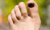 Black toenail