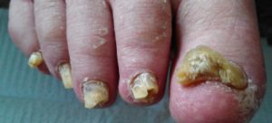 Toenail fungus photo